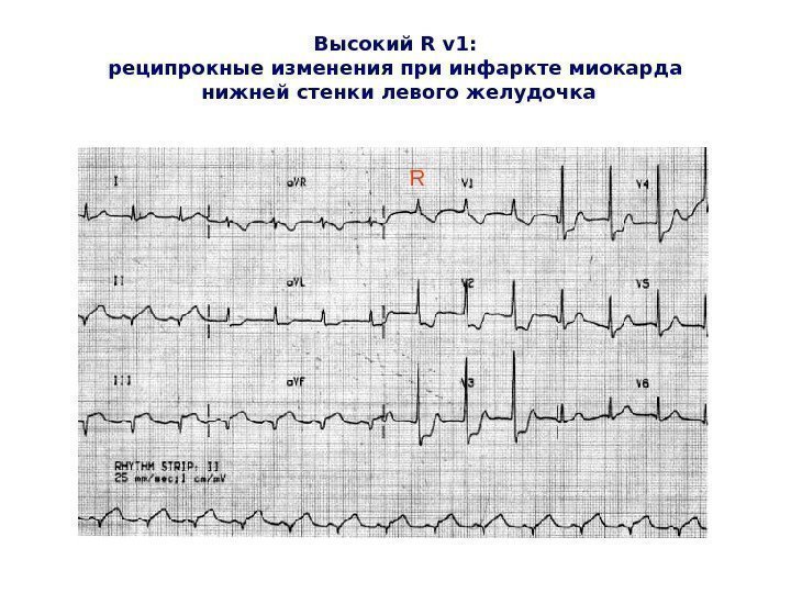   Высокий R v 1 : реципрокные изменения при инфаркте миокарда нижней стенки