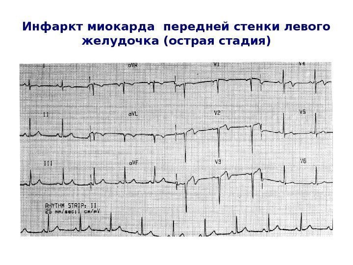   Инфаркт миокарда передней стенки левого желудочка (острая стадия) 