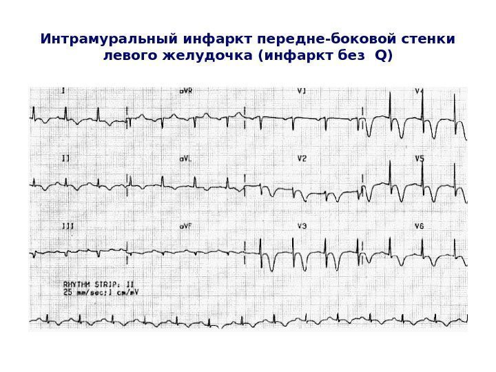   Интрамуральный инфаркт передне-боковой стенки левого желудочка (инфаркт без  Q) 