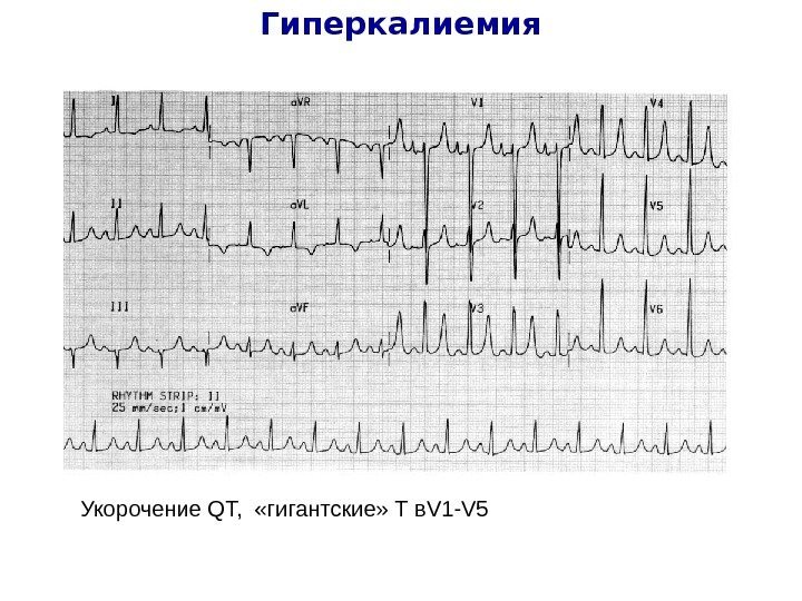   Гиперкалиемия Укорочение QT, «гигантские» Т в V 1 -V 5 