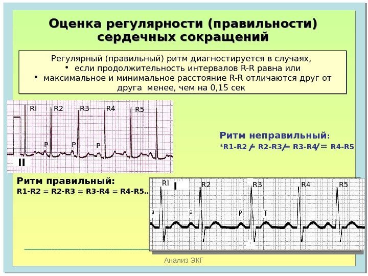   Анализ ЭКГОценка регулярности (правильности) сердечных сокращений Регулярный (правильный) ритм диагностируется в случаях,