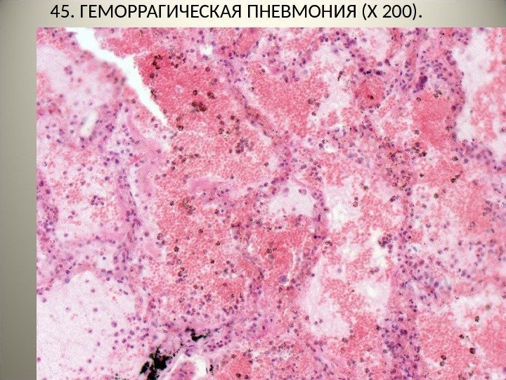  45. ГЕМОРРАГИЧЕСКАЯ ПНЕВМОНИЯ ( Х 200 ). . .    