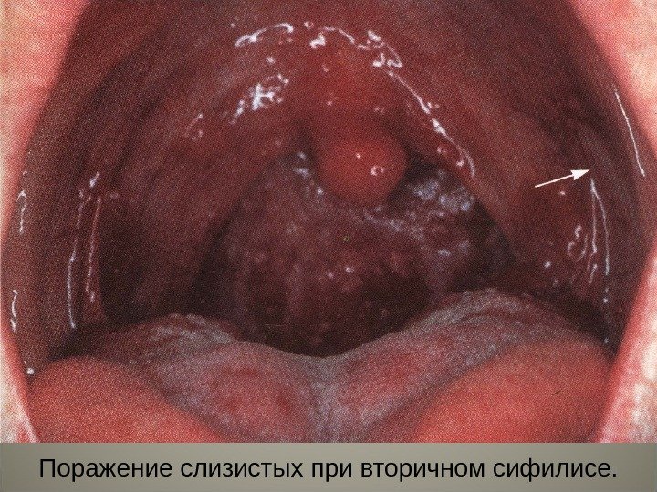 18 Поражение слизистых при вторичном сифилисе. 