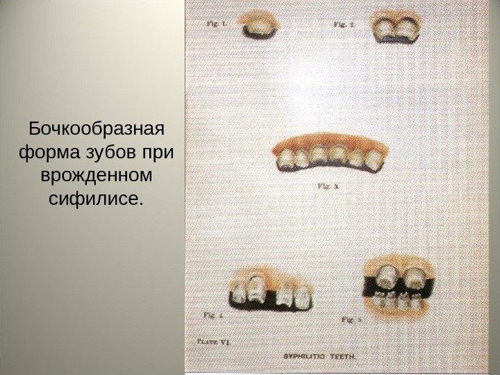 48 Бочкообразная форма зубов при врожденном сифилисе. 