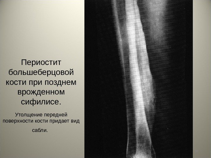 50 Периостит большеберцовой кости при позднем врожденном сифилисе. Утолщение передней поверхности кости придает вид