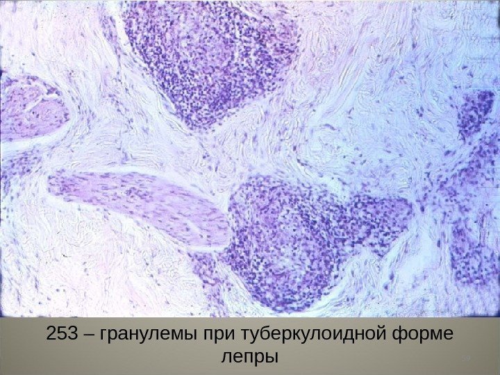 59253 – гранулемы при туберкулоидной форме лепры 