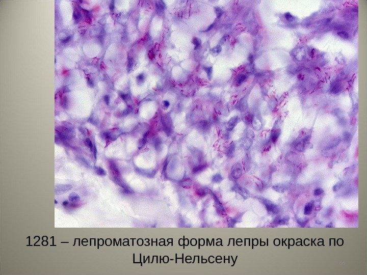 661281 – лепроматозная форма лепры окраска по Цилю-Нельсену 