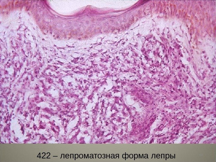 68 422 – лепроматозная форма лепры 