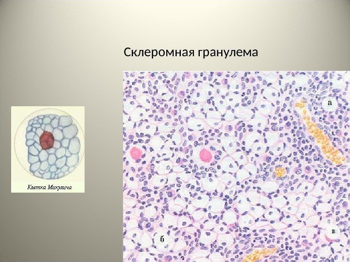 72 Склеромная гранулема 