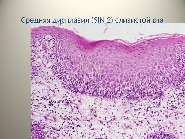 Средняя дисплазия ( SIN 2 ) слизистой рта 20 