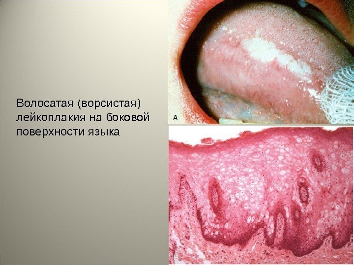 Волосатая (ворсистая) лейкоплакия на боковой поверхности языка 