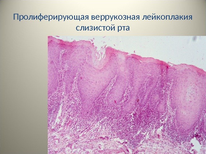 Пролиферирующая веррукозная лейкоплакия слизистой рта 34 
