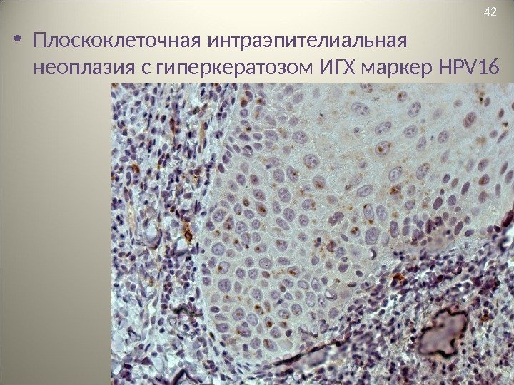  • Плоскоклеточная интраэпителиальная неоплазия с гиперкератозом ИГХ маркер HPV 16 42 