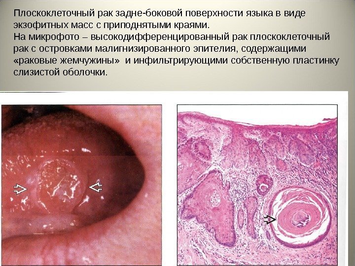 Плоскоклеточный рак задне-боковой поверхности языка в виде экзофитных масс с приподнятыми краями. На микрофото