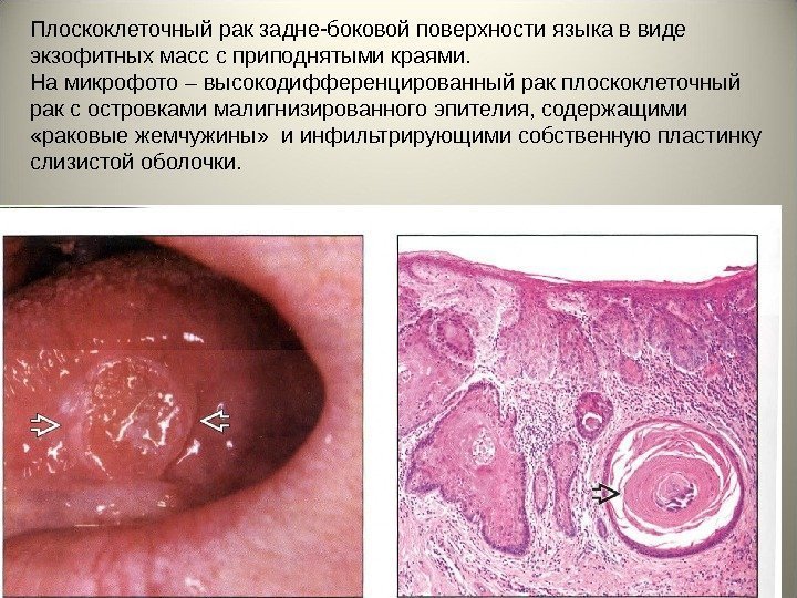 Плоскоклеточный рак слизистой рта фото
