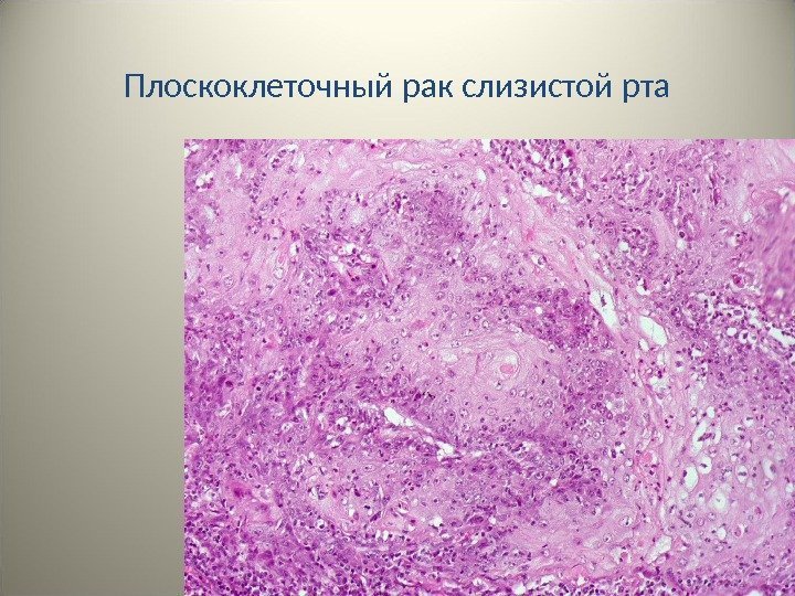 Плоскоклеточный рак слизистой рта 56 