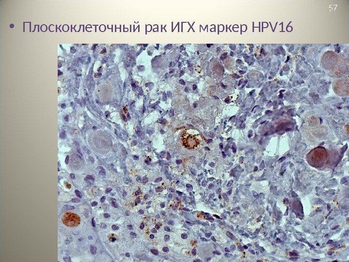  • Плоскоклеточный рак ИГХ маркер HPV 16 57 