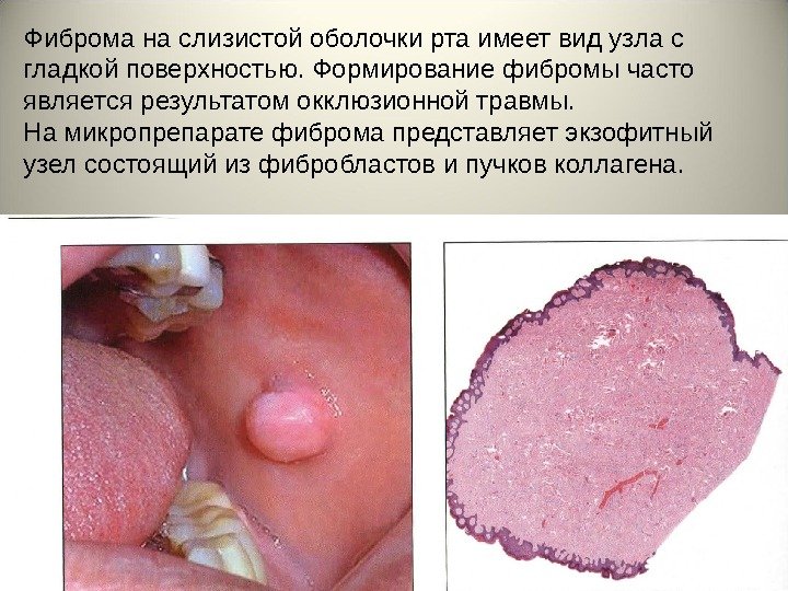 Фиброма на слизистой оболочки рта имеет вид узла с гладкой поверхностью. Формирование фибромы часто