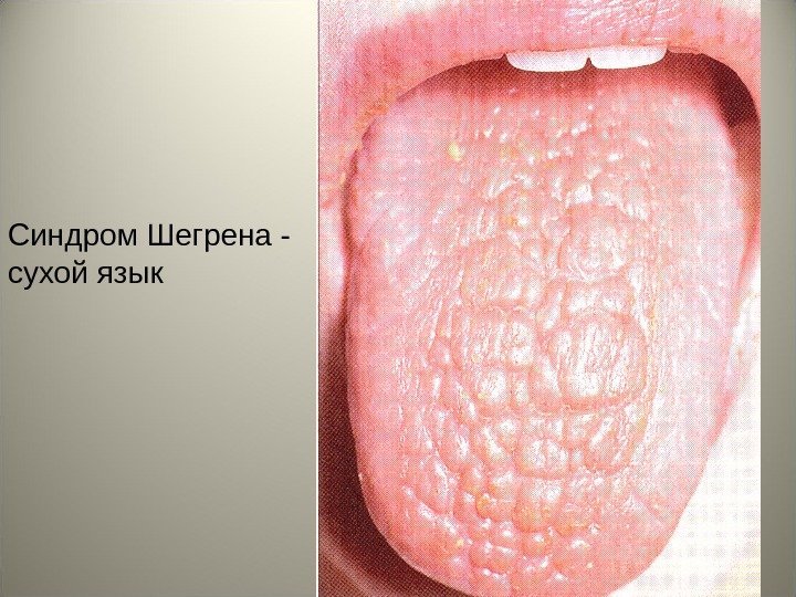 23 Синдром Шегрена - сухой язык 
