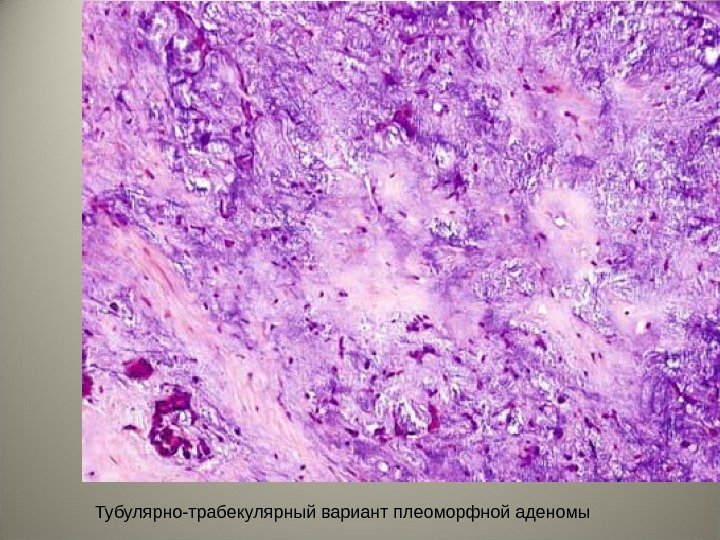 Тубулярно-трабекулярный вариант плеоморфной аденомы 