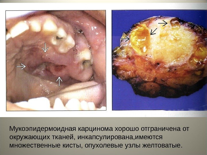 Мукоэпидермоидная карцинома хорошо отграничена от окружающих тканей, инкапсулирована, имеются множественные кисты, опухолевые узлы желтоватые.