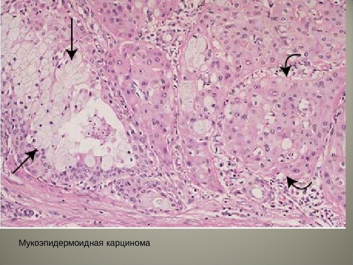 Мукоэпидермоидная карцинома 