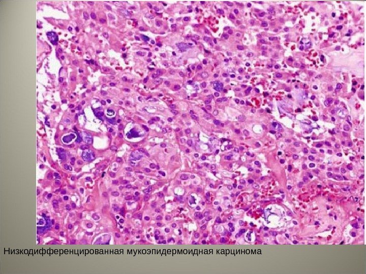 Низкодифференцированная мукоэпидермоидная карцинома 