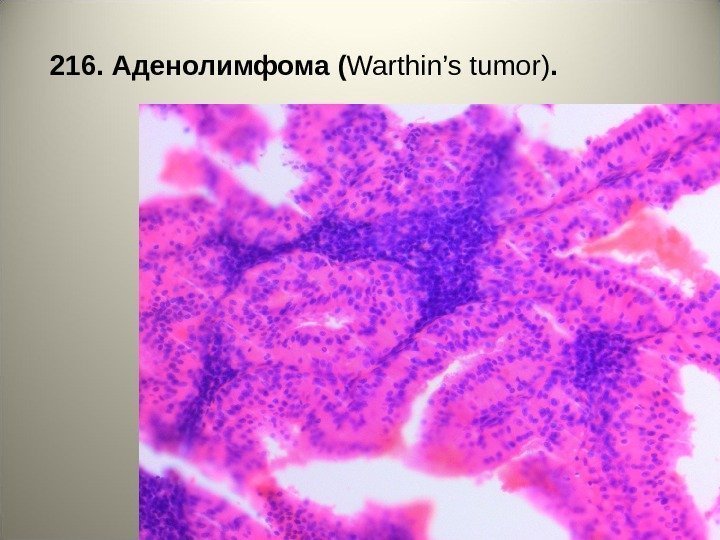 216. Аденолимфома ( Warthin’s tumor ).  
