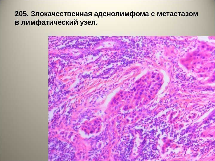 2 0 5. Злокачественная аденолимфома с метастазом в лимфатический узел.  