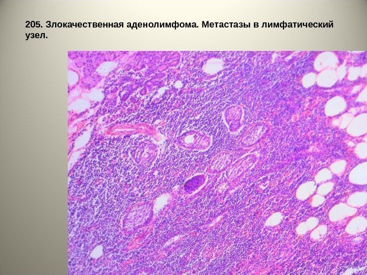 2 0 5. Злокачественная аденолимфома. Метастазы в лимфатический узел.  