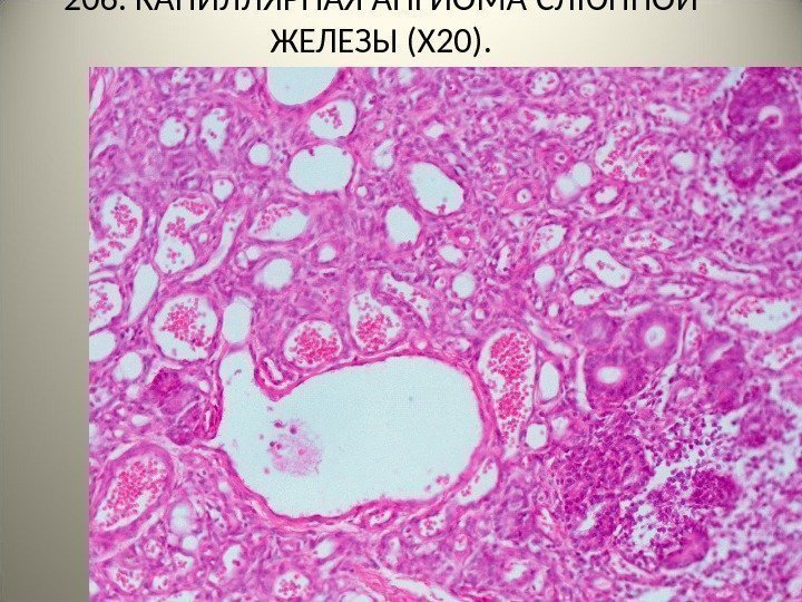 206. КАПИЛЛЯРНАЯ АНГИОМА  СЛЮННОЙ ЖЕЛЕЗЫ (Х 20). .     