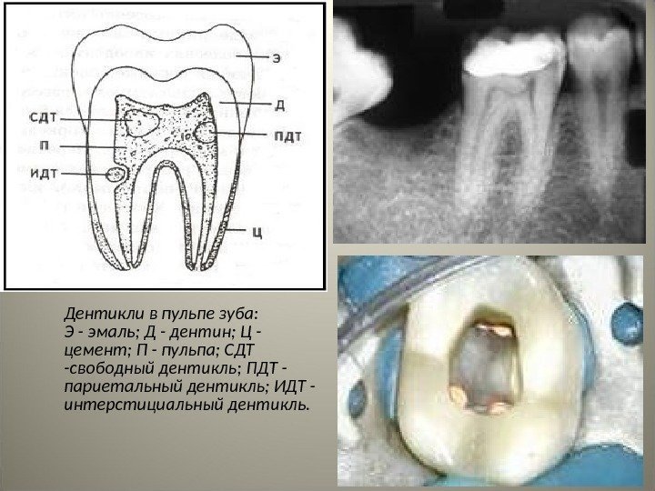 Дентикли в пульпе зуба:    Э - эмаль; Д - дентин; Ц