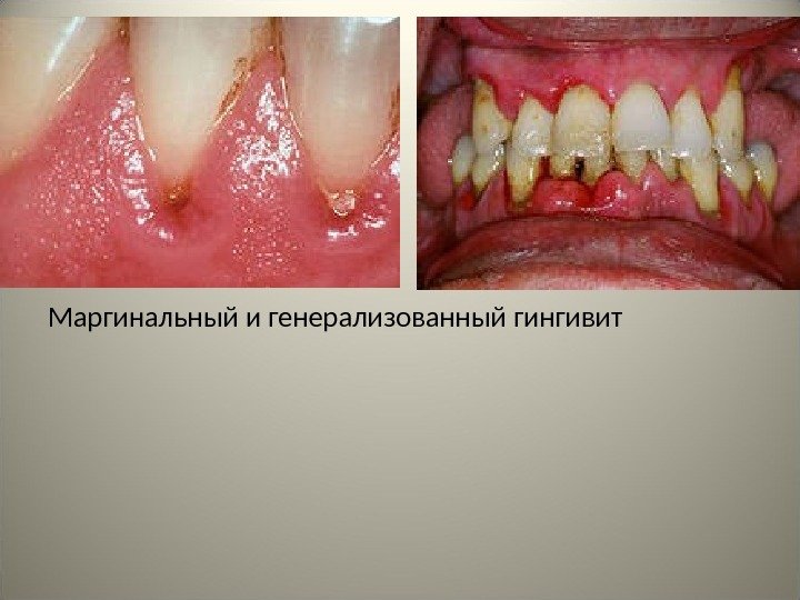 Маргинальный и генерализованный гингивит 