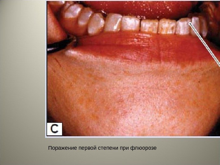 Поражение первой степени при флюорозе 