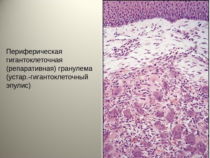 Периферическая гигантоклеточная (репаративная) гранулема (устар. -гигантоклеточный эпулис) 