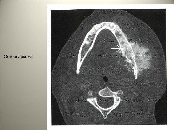 Остеосаркома 