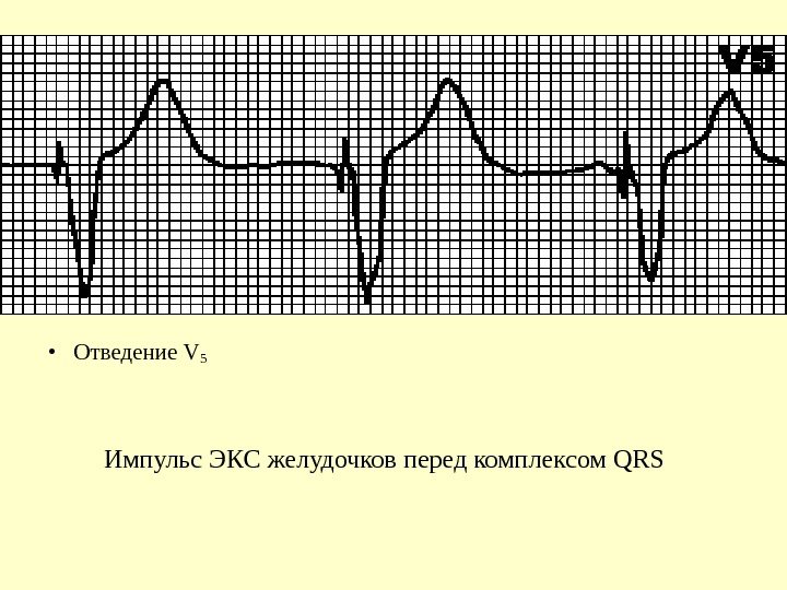   • Отведение V 5 Импульс ЭКС желудочков перед комплексом QRS  