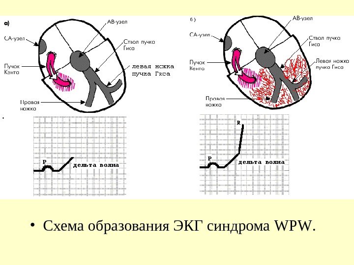   • Схема образования ЭКГ синдрома WPW.  