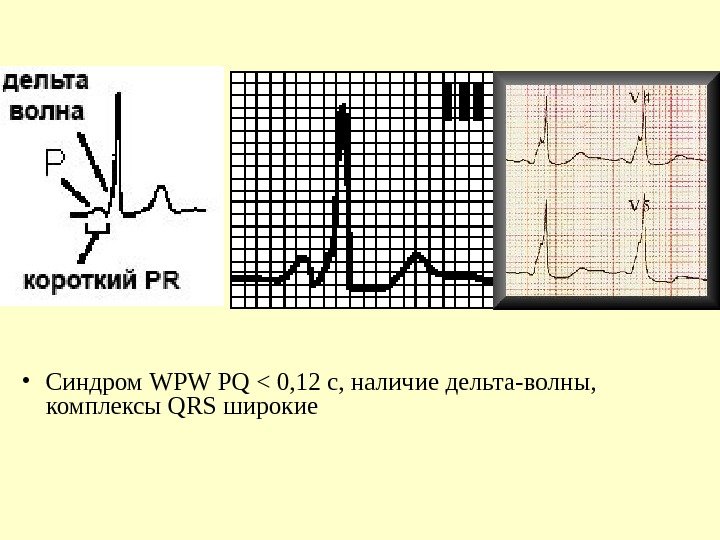   • Синдром WPW PQ  0, 12 с, наличие дельта-волны,  комплексы