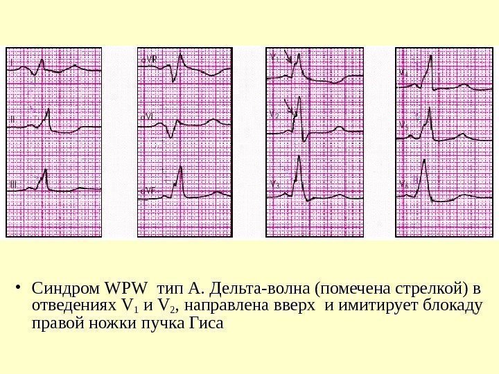   • Синдром WPW  тип А. Дельта-волна (помечена стрелкой) в отведениях V