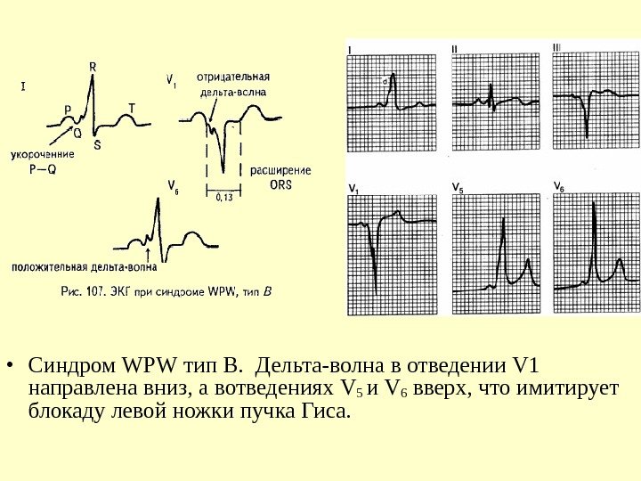   • Синдром WPW тип B.  Дельта-волна в отведении V 1 направлена