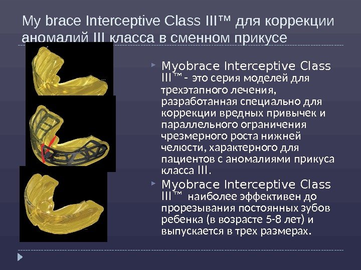 My brace Interceptive Class III™ для коррекции аномалий III класса в сменном прикусе Myobrace