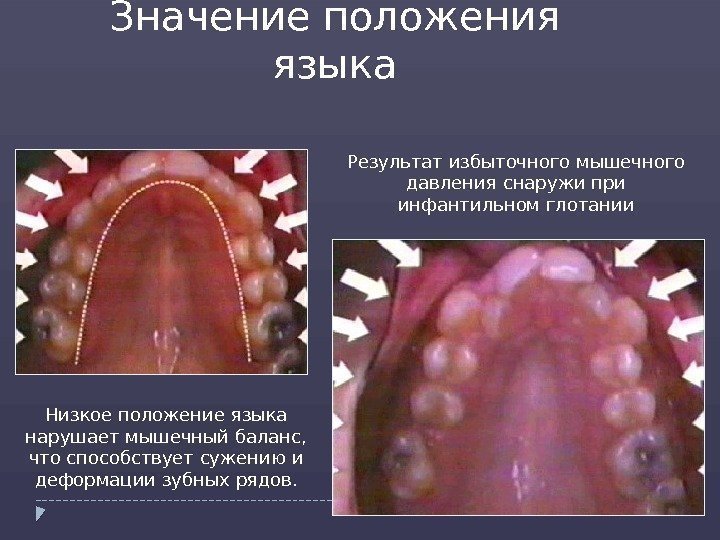 Значение положения языка Низкое положение языка нарушает мышечный баланс,  что способствует сужению и