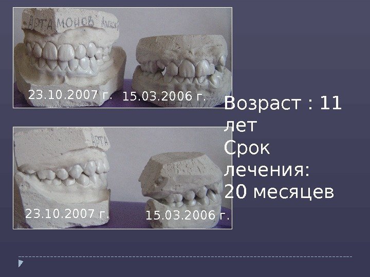 23. 10. 2007 г. 15. 03. 2006 г. Возраст : 11 лет Срок лечения: