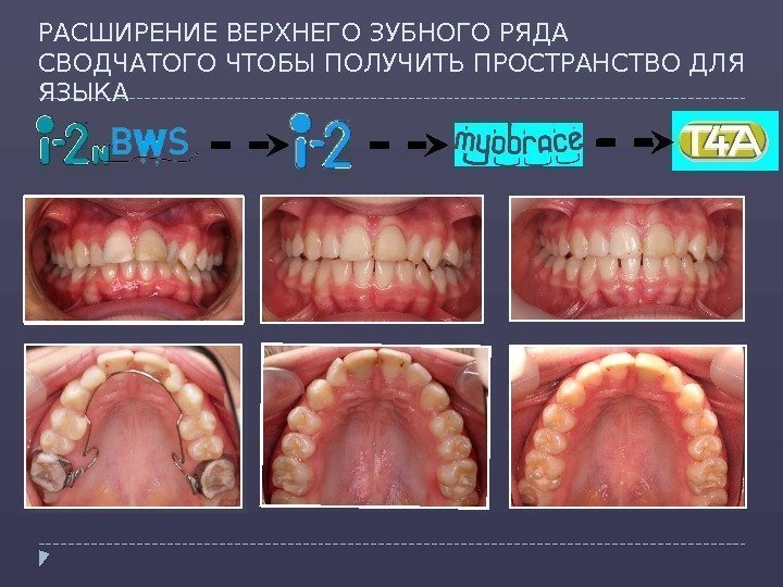 РАСШИРЕНИЕ ВЕРХНЕГО ЗУБНОГО РЯДА СВОДЧАТОГО ЧТОБЫ ПОЛУЧИТЬ ПРОСТРАНСТВО ДЛЯ ЯЗЫКА   