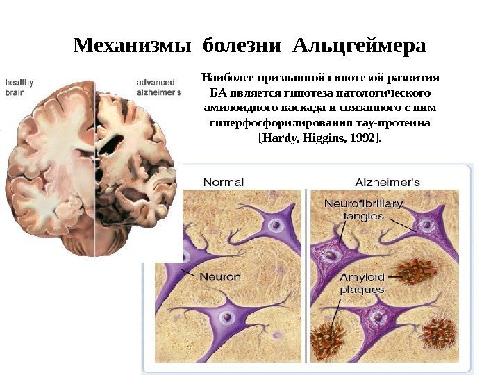 Механизмы болезни Альцгеймера Наиболее признанной гипотезой развития БА является гипотеза патологического амилоидного каскада и
