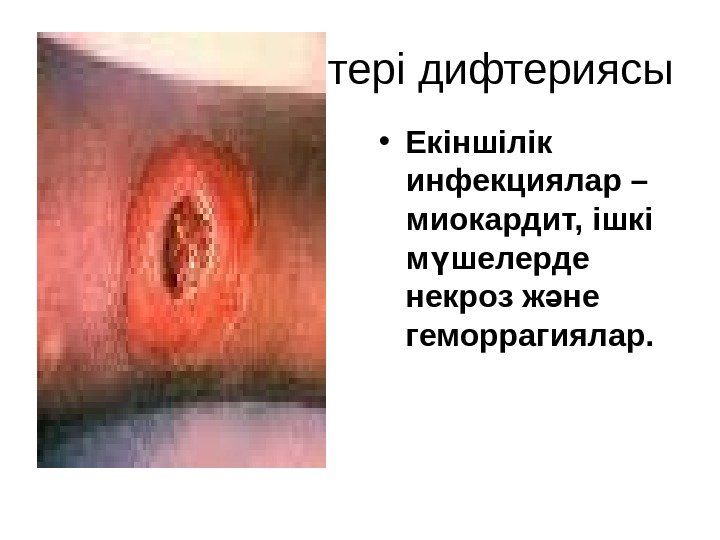    тері дифтериясы • Екіншілік инфекциялар – миокардит, ішкі м шелерде