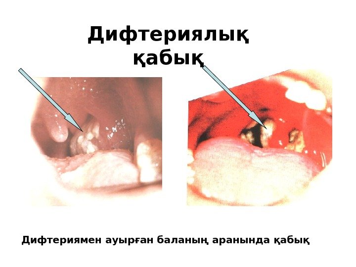 Дифтериялық қабық Дифтериямен ауырған баланың аранында қабық 