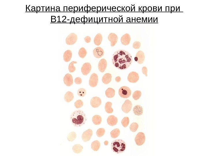 Картина периферической крови при В 12 -дефицитной анемии 