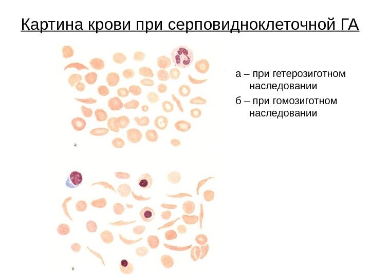 Картина крови при серповидноклеточной ГА а – при гетерозиготном наследовании б – при гомозиготном